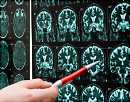 Iowa clinicians herald new Alzheimer’s treatments
